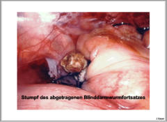 Appendixstumpf nach entferntem Binddarmwurmfortsatz